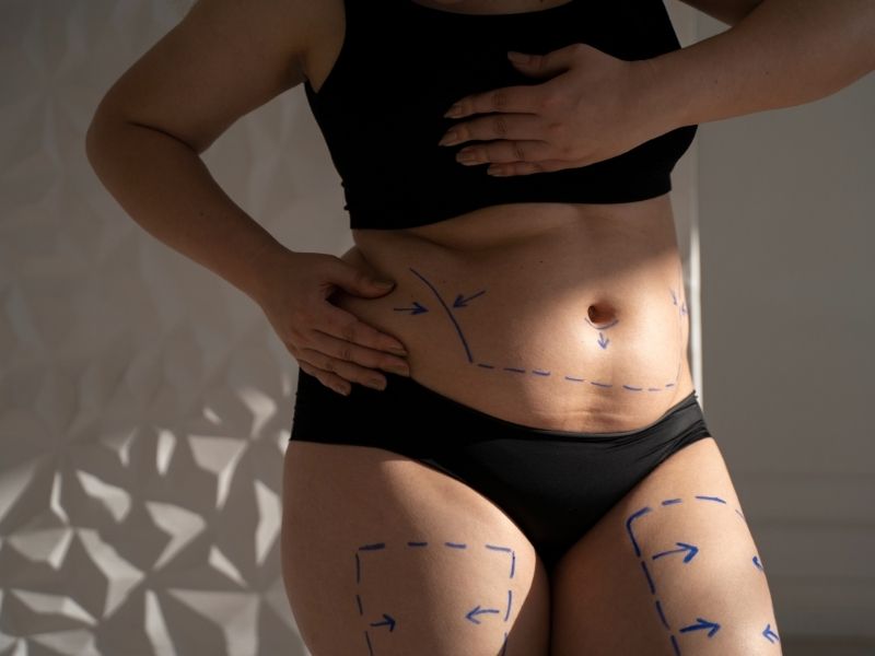 liposuction-kimlere-uygulanir